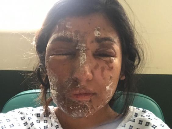 Acid Attack Survivor Shared How She Looks Now! Twitter Is Loving Her Beauty - RVCJ Media